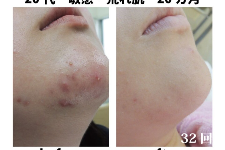 ビフォーアフター写真、大人ニキビ（20代）